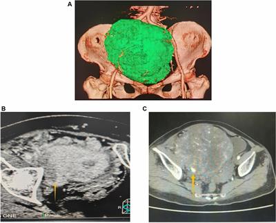 Case report: A huge retroperitoneal solitary fibrous tumor closely related to the external iliac vessels misdiagnosed as an ovarian tumor